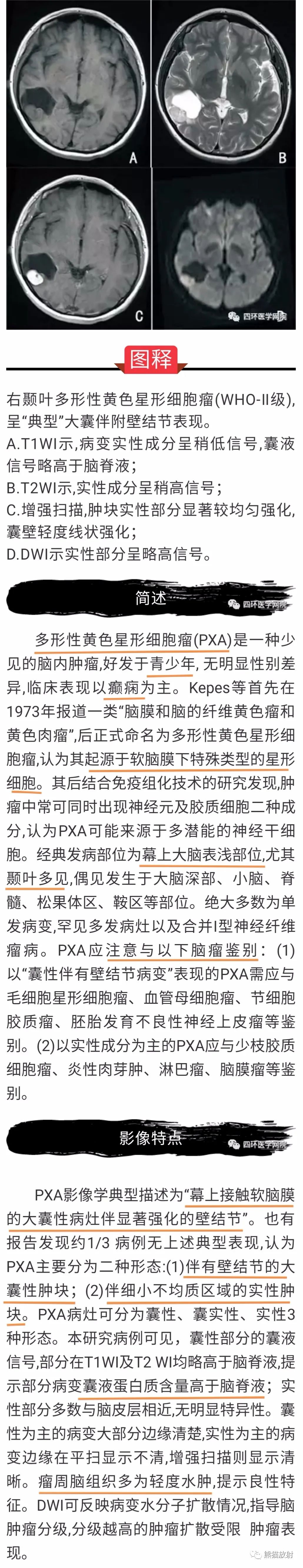 【病例】多形性黄色星形细胞瘤1例MR影像 【病例】多形性黄色星形细胞瘤1例MR影像