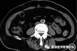 腹腔局灶性脂肪坏死的典型影像学征象及其鉴别诊断 腹腔局灶性脂肪坏死的典型影像学征象及其鉴别诊断