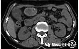 腹腔局灶性脂肪坏死的典型影像学征象及其鉴别诊断 腹腔局灶性脂肪坏死的典型影像学征象及其鉴别诊断