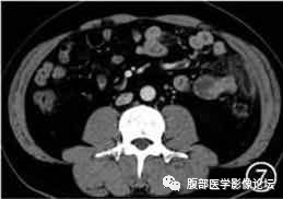 腹腔局灶性脂肪坏死的典型影像学征象及其鉴别诊断 腹腔局灶性脂肪坏死的典型影像学征象及其鉴别诊断