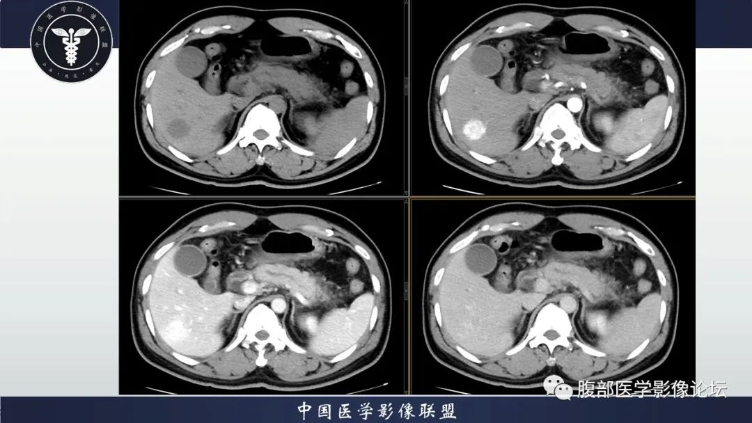 【病例】神经内分泌肿瘤伴肝转移1例CT影像讨论 【病例】神经内分泌肿瘤伴肝转移1例CT影像讨论