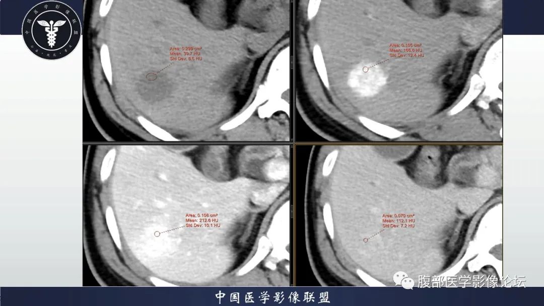 【病例】神经内分泌肿瘤伴肝转移1例CT影像讨论 【病例】神经内分泌肿瘤伴肝转移1例CT影像讨论