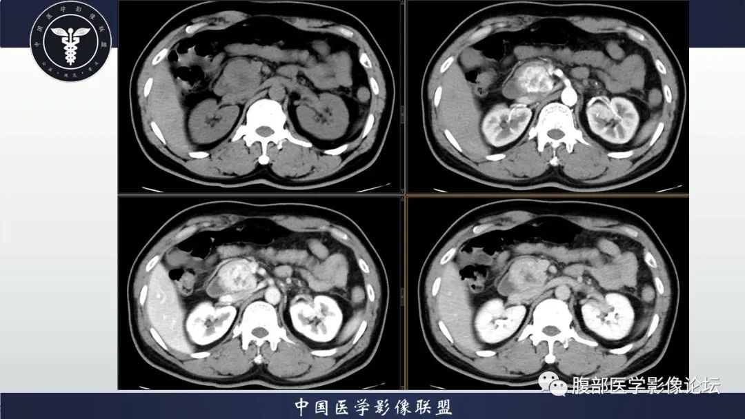 【病例】神经内分泌肿瘤伴肝转移1例CT影像讨论 【病例】神经内分泌肿瘤伴肝转移1例CT影像讨论