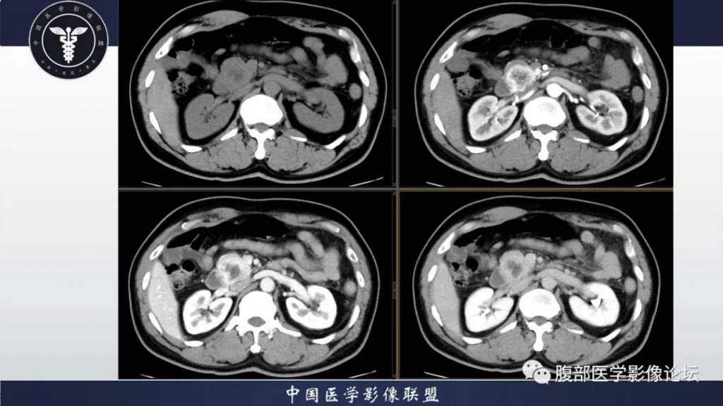 【病例】神经内分泌肿瘤伴肝转移1例CT影像讨论
