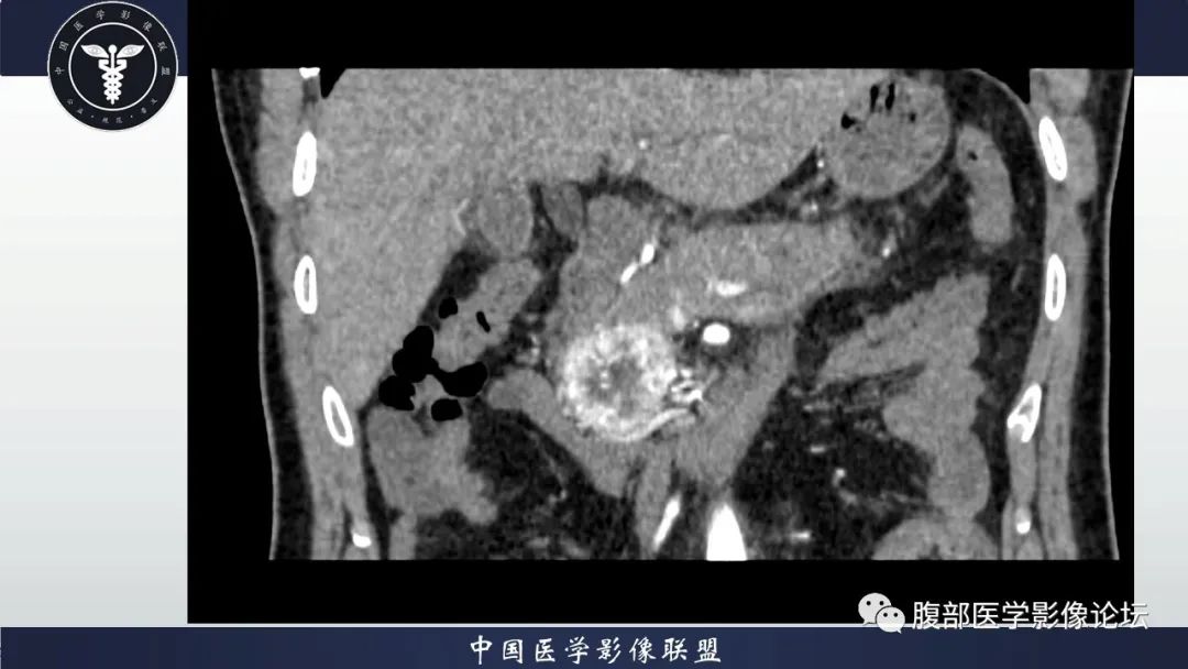 【病例】神经内分泌肿瘤伴肝转移1例CT影像讨论 【病例】神经内分泌肿瘤伴肝转移1例CT影像讨论