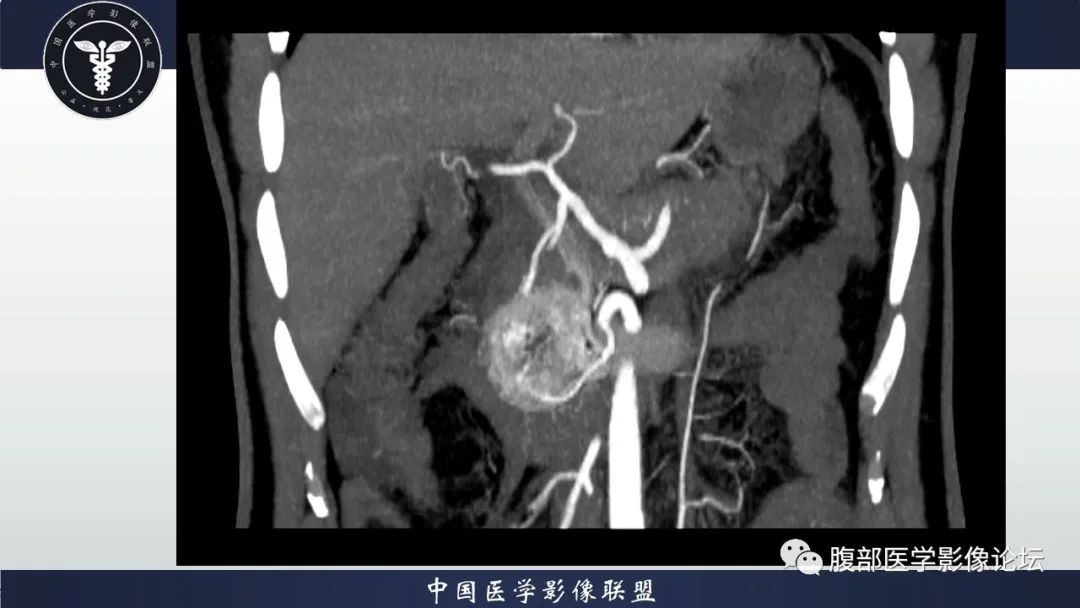 【病例】神经内分泌肿瘤伴肝转移1例CT影像讨论 【病例】神经内分泌肿瘤伴肝转移1例CT影像讨论