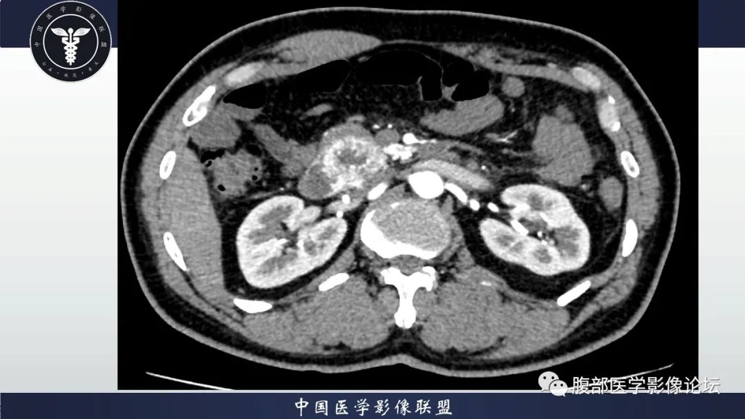 【病例】神经内分泌肿瘤伴肝转移1例CT影像讨论 【病例】神经内分泌肿瘤伴肝转移1例CT影像讨论