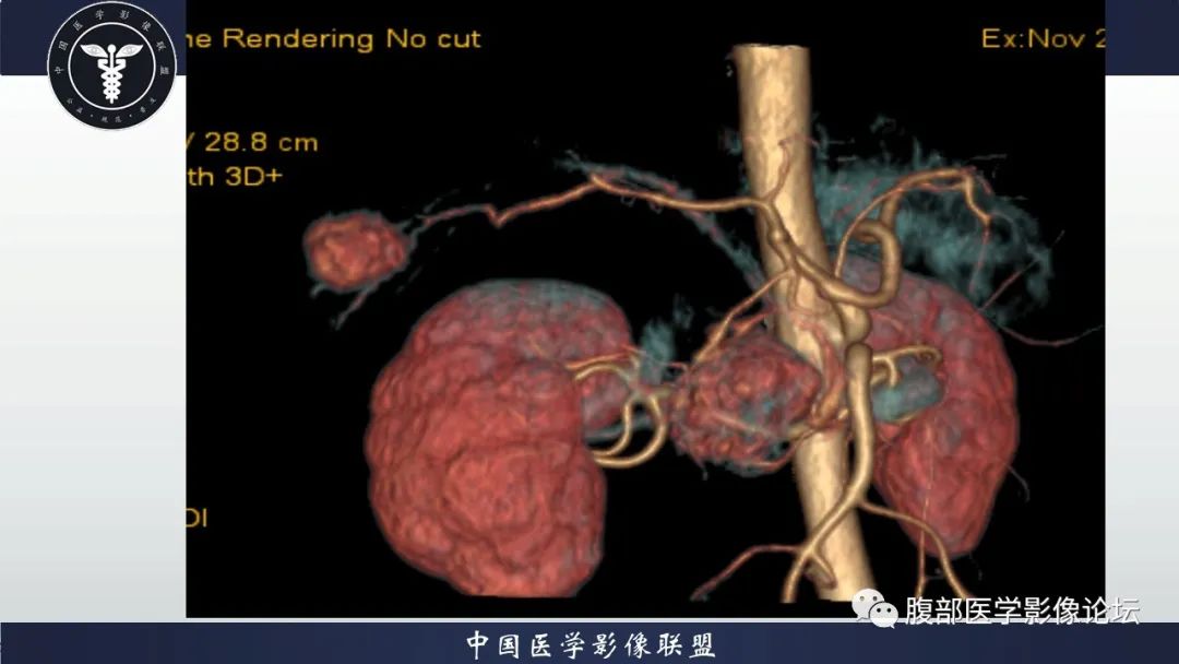 【病例】神经内分泌肿瘤伴肝转移1例CT影像讨论 【病例】神经内分泌肿瘤伴肝转移1例CT影像讨论
