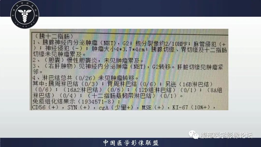 【病例】神经内分泌肿瘤伴肝转移1例CT影像讨论 【病例】神经内分泌肿瘤伴肝转移1例CT影像讨论