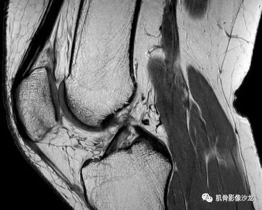 【病例】髌骨应力性骨折1例MR影像 【病例】髌骨应力性骨折1例MR影像