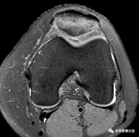 【病例】髌骨应力性骨折1例MR影像 【病例】髌骨应力性骨折1例MR影像