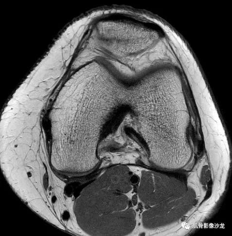 【病例】髌骨应力性骨折1例MR影像 【病例】髌骨应力性骨折1例MR影像