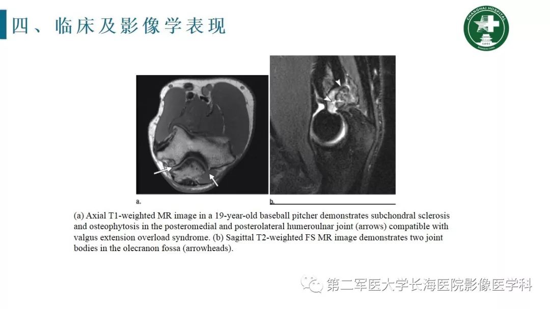 【PPT】肘关节运动损伤MR诊断