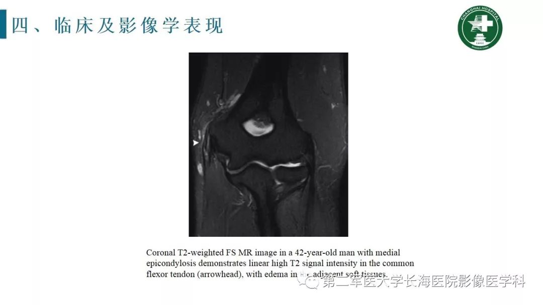 【PPT】肘关节运动损伤MR诊断