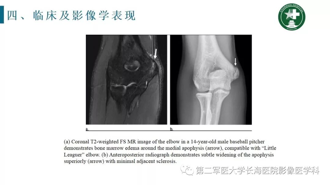 【PPT】肘关节运动损伤MR诊断