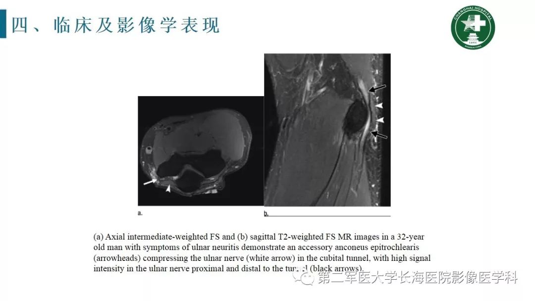 【PPT】肘关节运动损伤MR诊断