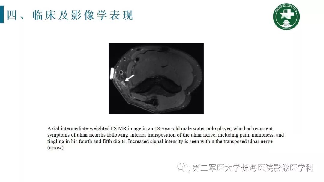 【PPT】肘关节运动损伤MR诊断