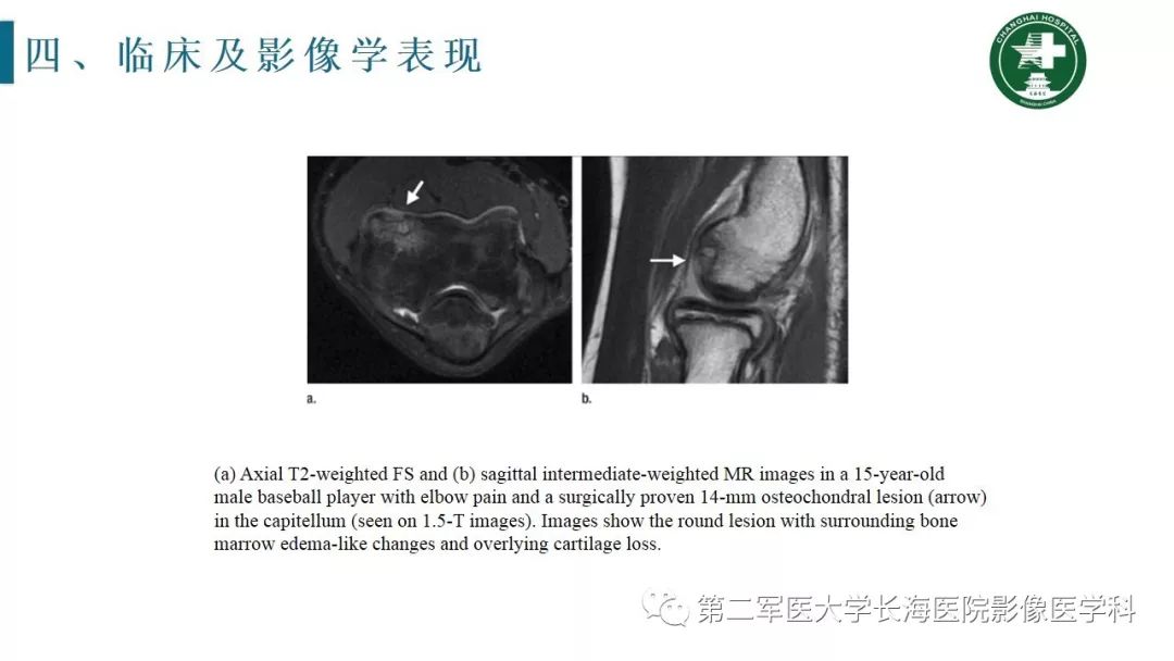 【PPT】肘关节运动损伤MR诊断