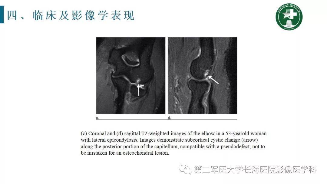 【PPT】肘关节运动损伤MR诊断