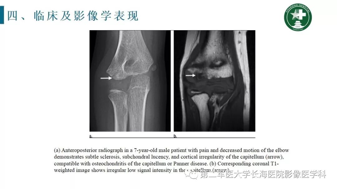 【PPT】肘关节运动损伤MR诊断