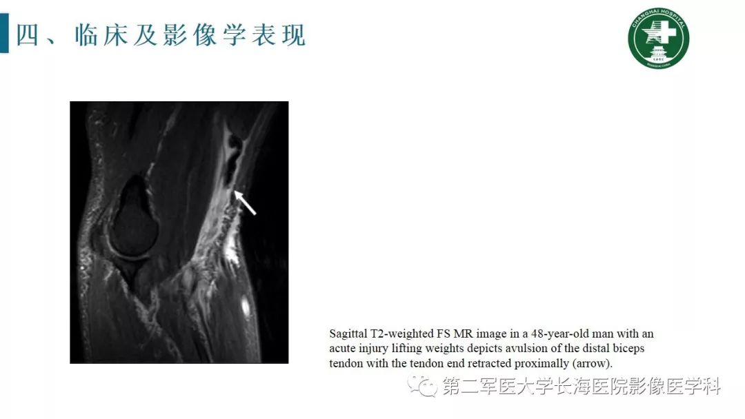 【PPT】肘关节运动损伤MR诊断