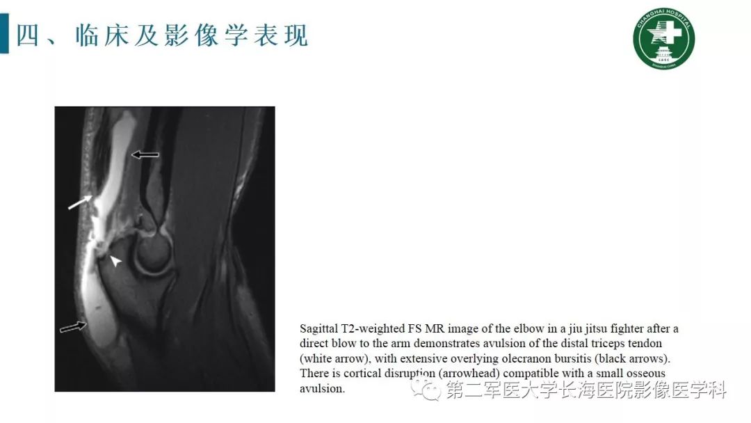 【PPT】肘关节运动损伤MR诊断