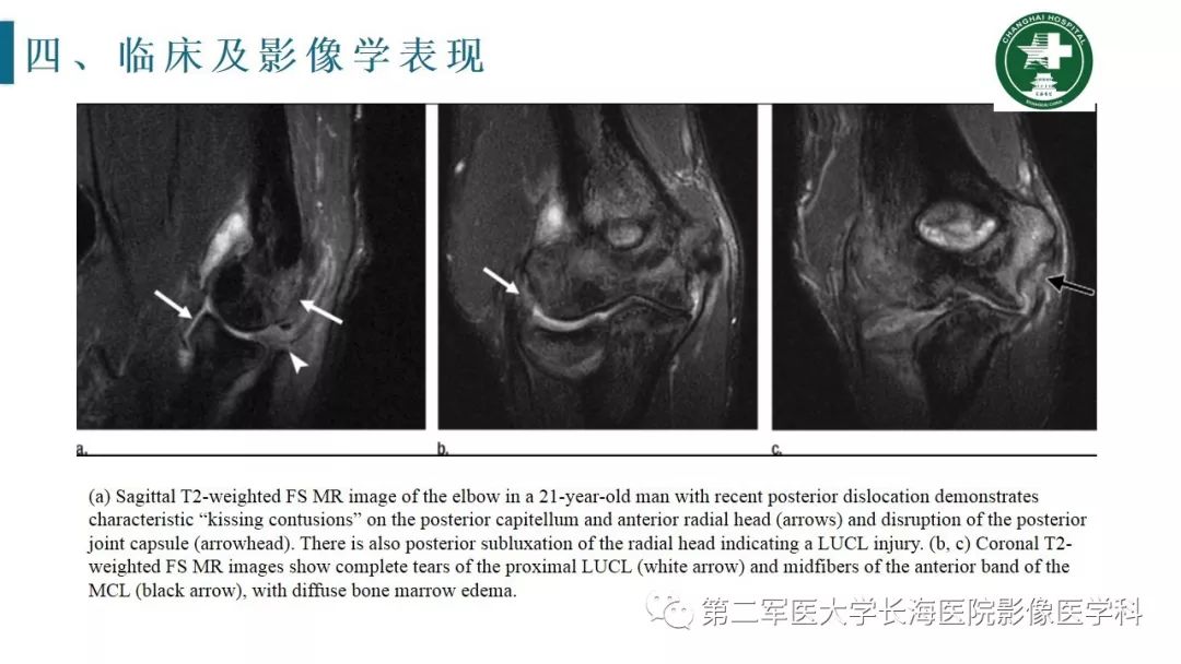【PPT】肘关节运动损伤MR诊断