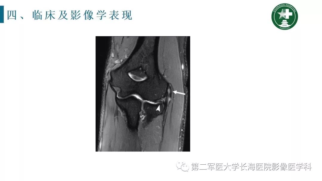 【PPT】肘关节运动损伤MR诊断