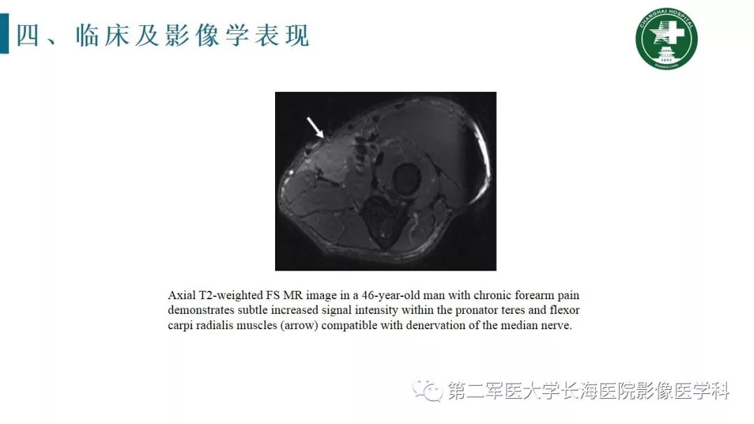 【PPT】肘关节运动损伤MR诊断