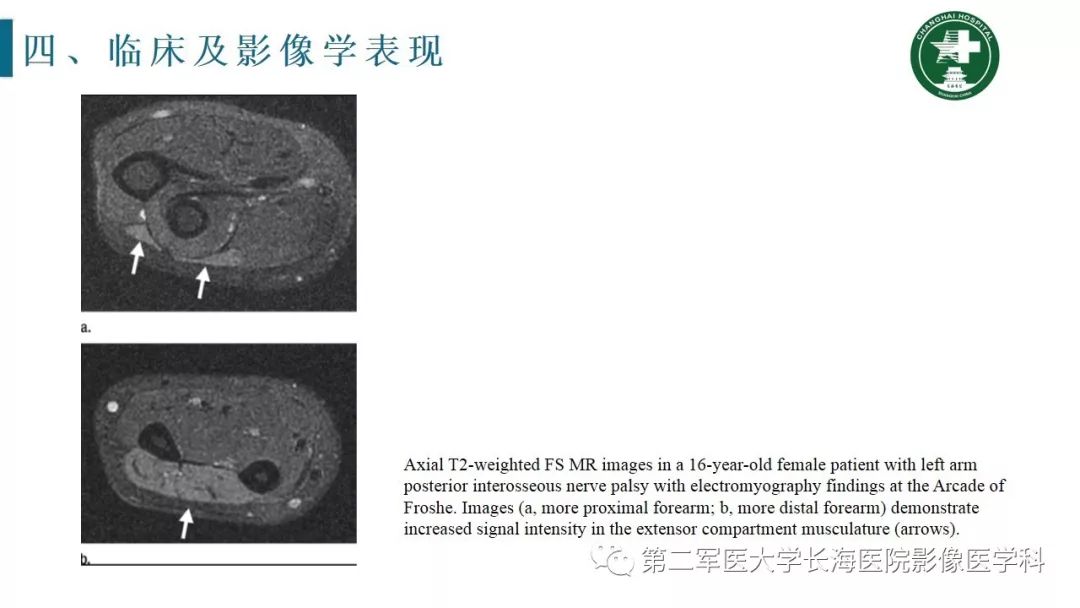 【PPT】肘关节运动损伤MR诊断