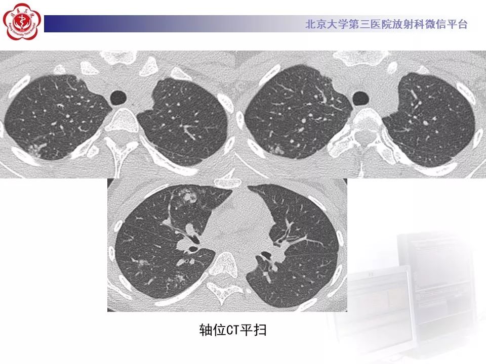 【PPT】遗传性出血性毛细血管扩张症