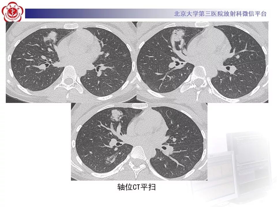 【PPT】遗传性出血性毛细血管扩张症