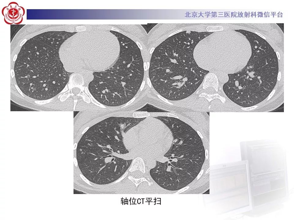 【PPT】遗传性出血性毛细血管扩张症
