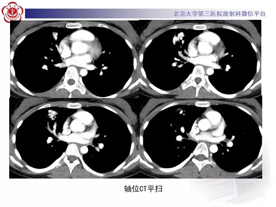 【PPT】遗传性出血性毛细血管扩张症