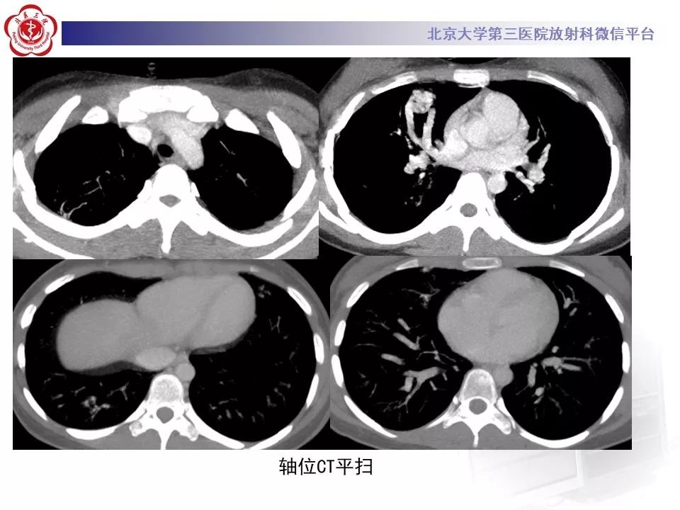 【PPT】遗传性出血性毛细血管扩张症