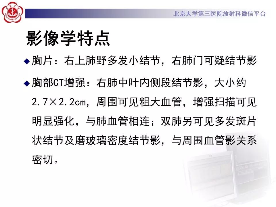 【PPT】遗传性出血性毛细血管扩张症