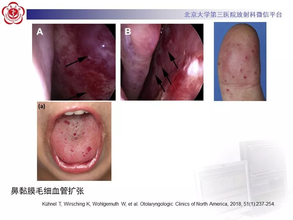 【PPT】遗传性出血性毛细血管扩张症