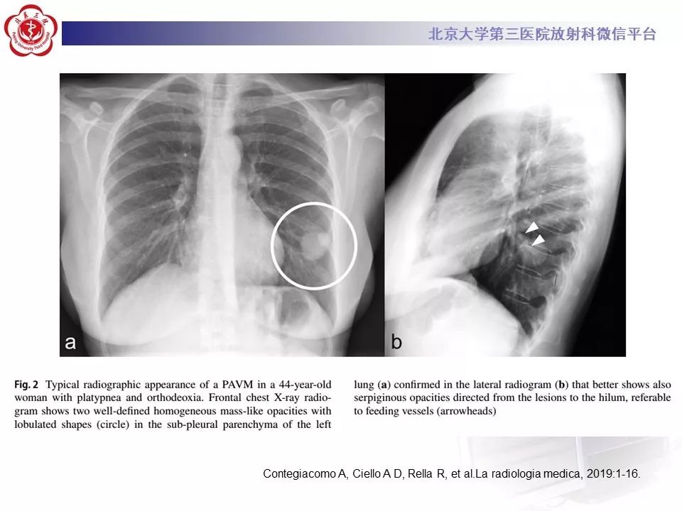 【PPT】遗传性出血性毛细血管扩张症