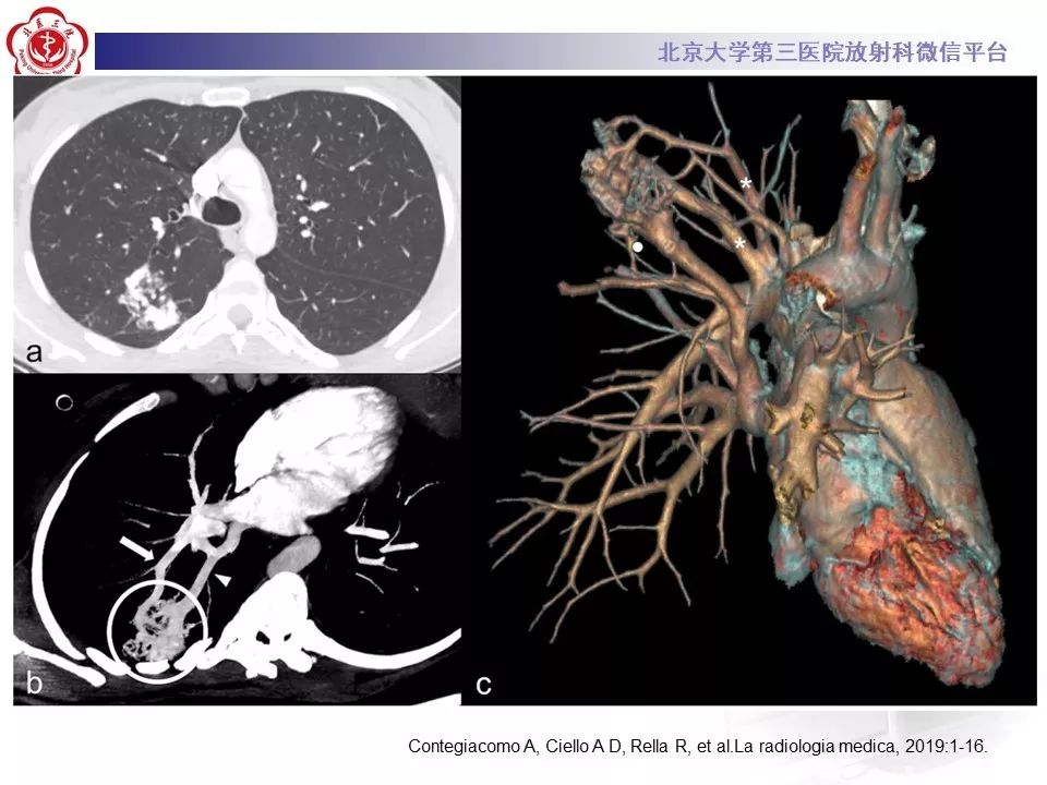 【PPT】遗传性出血性毛细血管扩张症