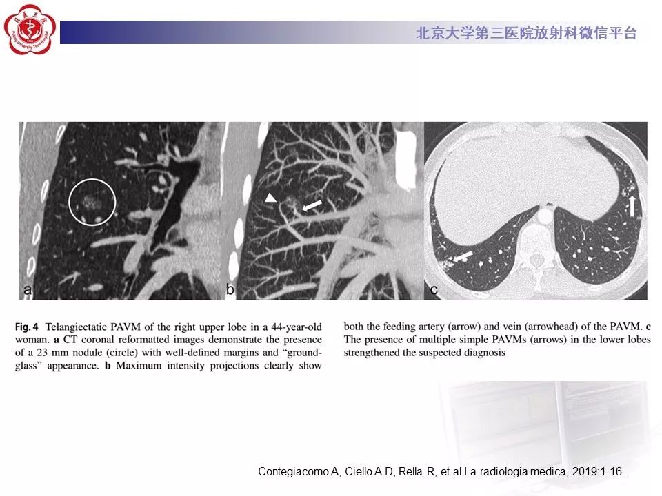 【PPT】遗传性出血性毛细血管扩张症