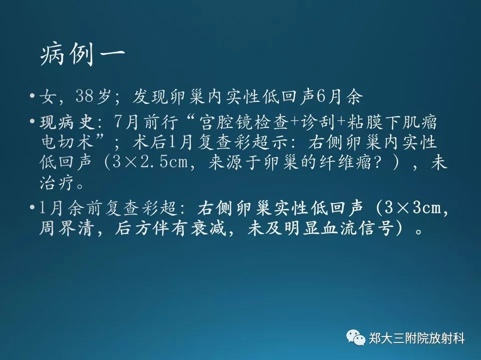 【PPT】卵泡膜纤维瘤的诊断及鉴别诊断