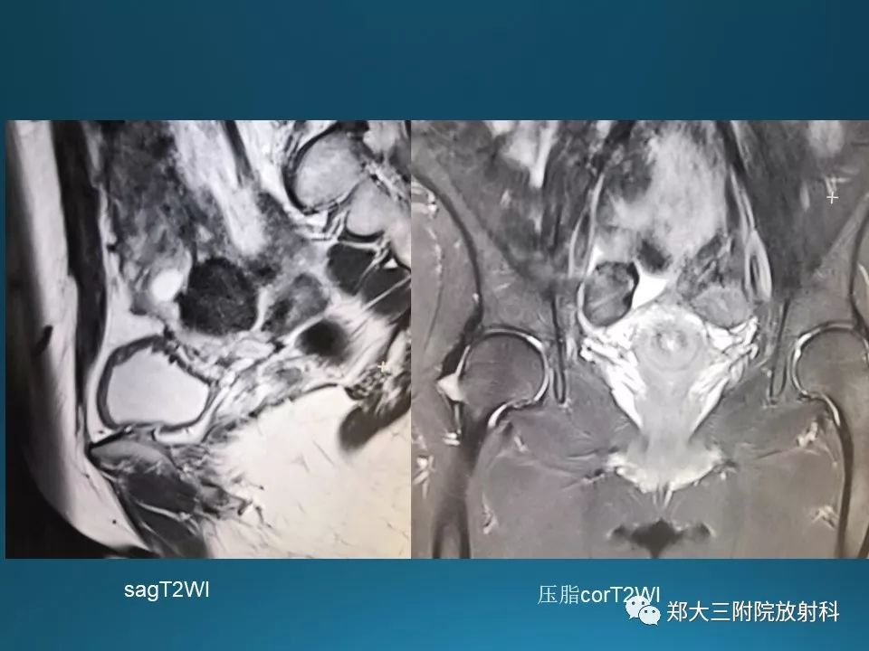 【PPT】卵泡膜纤维瘤的诊断及鉴别诊断