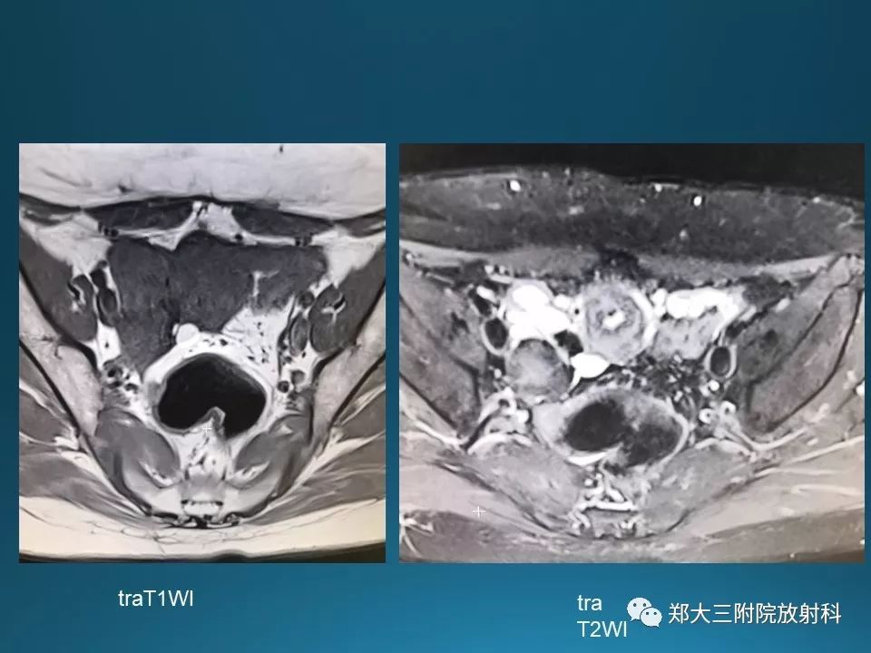 【PPT】卵泡膜纤维瘤的诊断及鉴别诊断