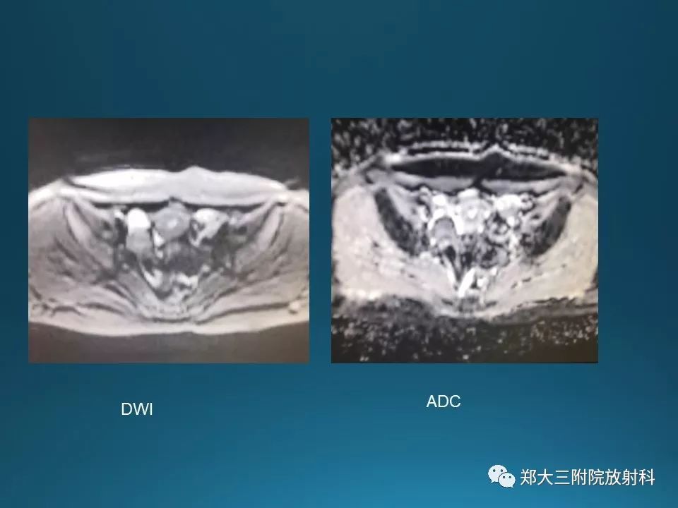 【PPT】卵泡膜纤维瘤的诊断及鉴别诊断