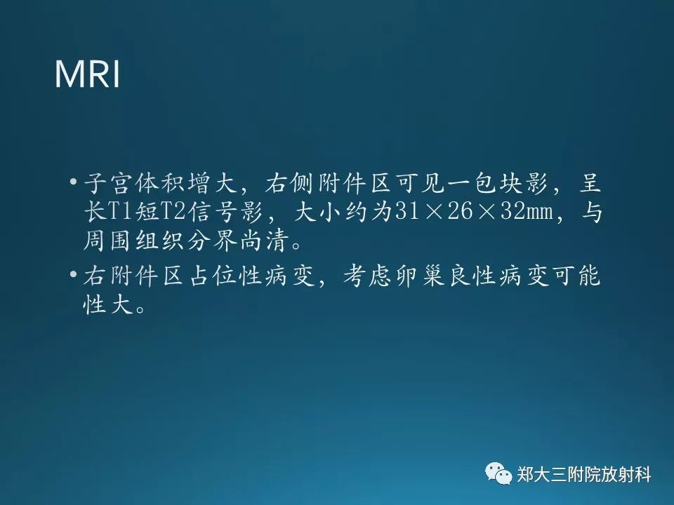 【PPT】卵泡膜纤维瘤的诊断及鉴别诊断