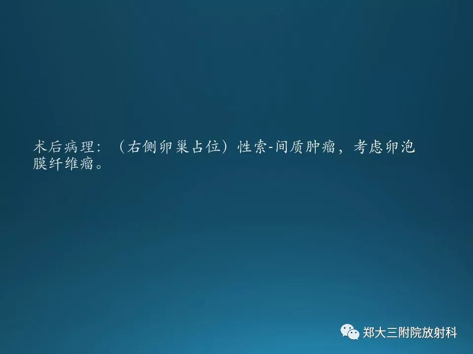 【PPT】卵泡膜纤维瘤的诊断及鉴别诊断