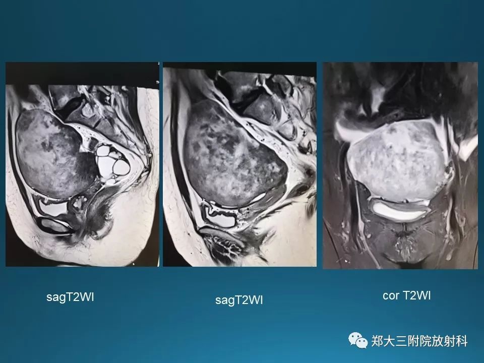 【PPT】卵泡膜纤维瘤的诊断及鉴别诊断
