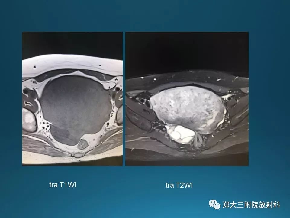 【PPT】卵泡膜纤维瘤的诊断及鉴别诊断