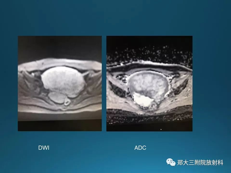 【PPT】卵泡膜纤维瘤的诊断及鉴别诊断