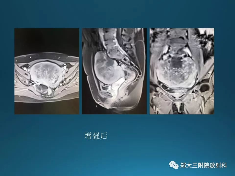 【PPT】卵泡膜纤维瘤的诊断及鉴别诊断